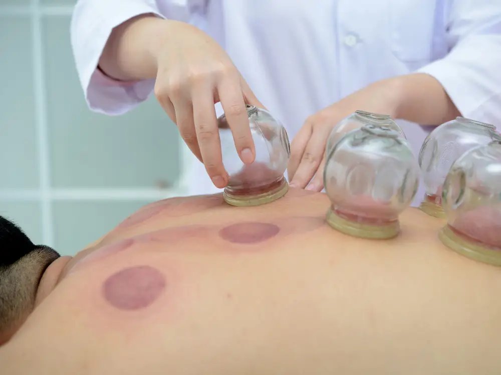 A professional cupping therapy set arranged neatly on a clean massage table.